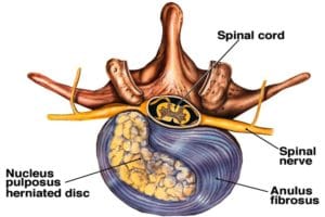 Hernie discale et constipation : comprendre le lien entre les deux